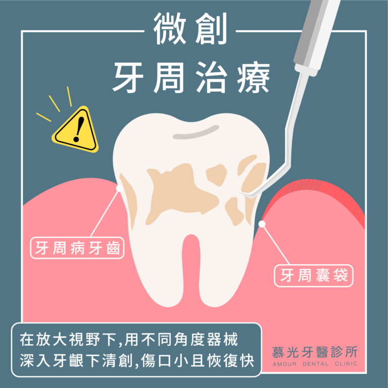 牙周微創手術+牙周抗生素凝膠｜副院長 林國義 醫師 - 慕光牙醫診所 台北中山區