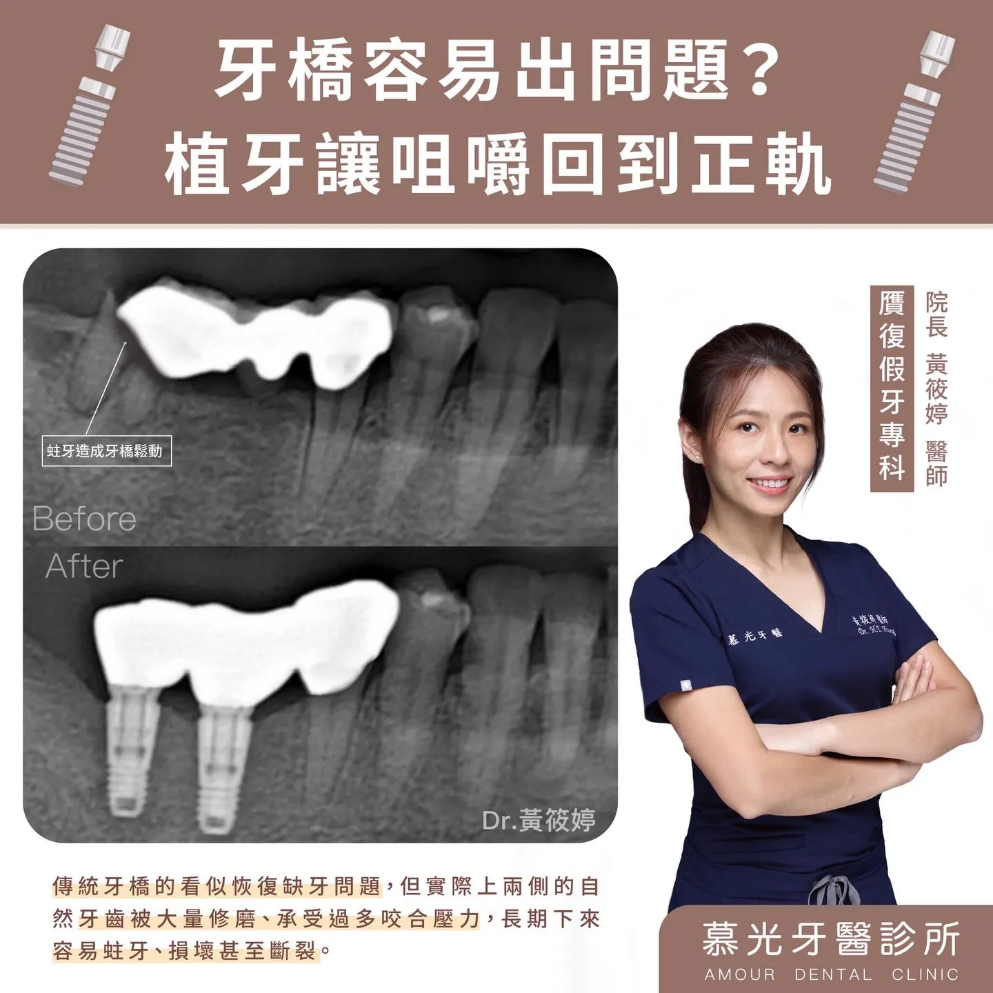 牙橋與植牙比較 牙橋容易出問題？植牙讓咀嚼回到正軌
